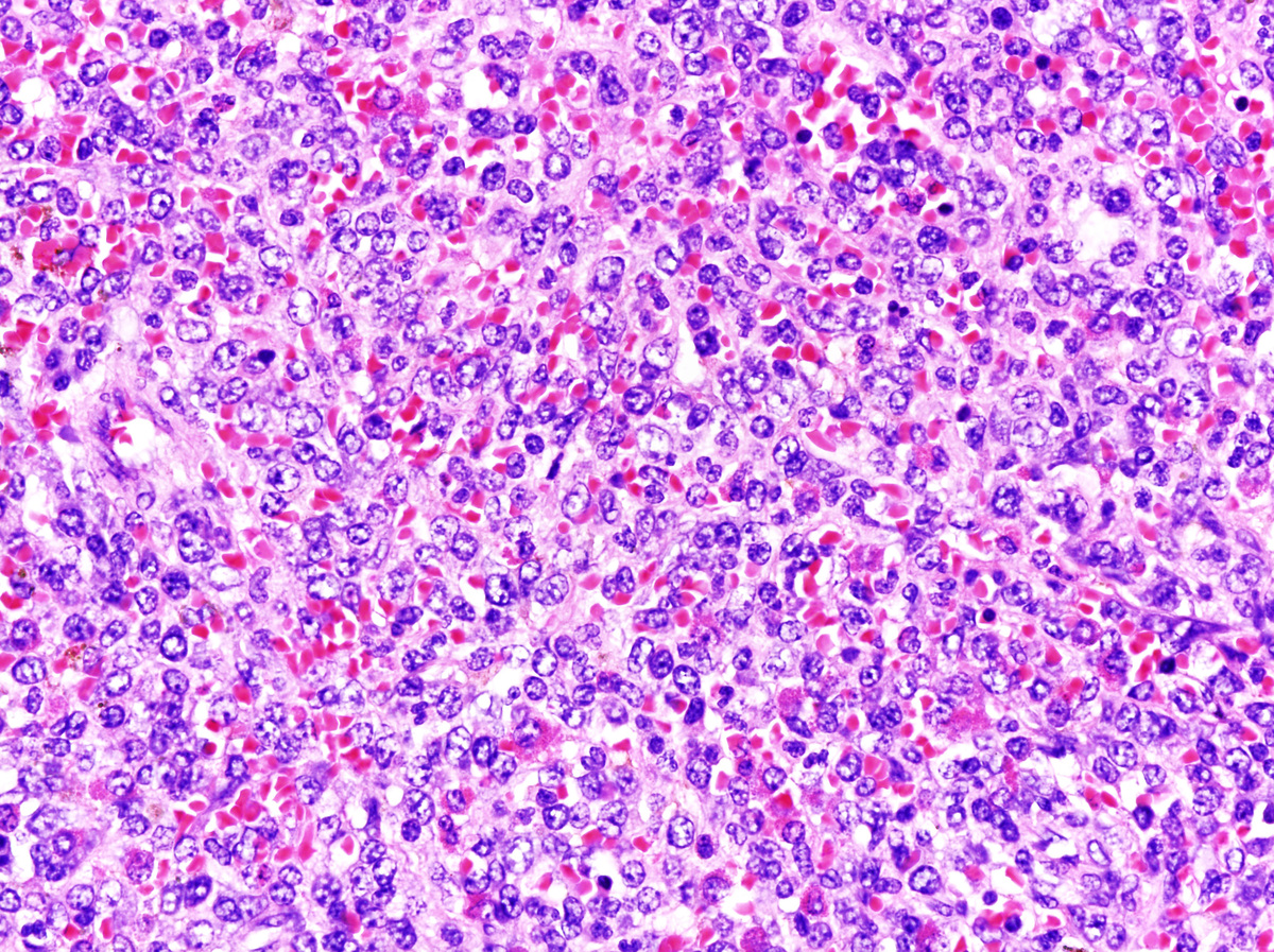 Sheet like proliferation of blasts in splenic red pulp c/w extramedullary  acute leukemic transformation in spleen